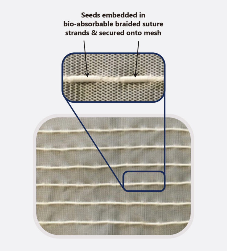 TheraMesh™ - a prefabricated, bio-absorbable implantable mesh embedded with TheraSeed® or AgX100® for permanent implantation.